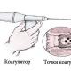 วิธีการผ่าตัดเอาริดสีดวงทวารออก: ขั้นตอนการผ่าตัด, ภาวะแทรกซ้อนที่เป็นไปได้, ภาวะแทรกซ้อน, การรักษา การผ่าตัดริดสีดวงทวารในช่องทวารหนัก