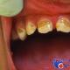Раптове потемніння зубної емалі - косметичний дефект або симптом грізного захворювання?