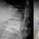 Діагностика та лікування компресійного перелому хребта Який лікар лікує