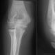 Перелом вінцевого відростка ліктьової кістки наслідки Перелом вінцевого відростка ліктьової кістки без усунення