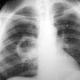 Абсцес легені: лікування