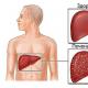Karaciğer sirozu şüphesi için hangi testler yapılır?