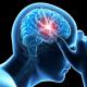 Ішемічна атака головного мозку симптоми Транзиторна ішемічна атака допомогу