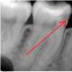 Ortopedi hastalarını muayene etmek için röntgen yöntemleri Dahili oral kontakt radyografi
