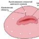 Ектропіон шийки матки: симптоми та лікування