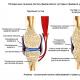 Причини, симптоми та лікування різних видів анкілозу Кістковий анкілоз тазостегнового суглоба