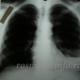 Гнійний плеврит легень: лікування, симптоми, наслідки
