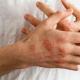 Причини та симптоми псоріазу шкіри: стадії розвитку, профілактика